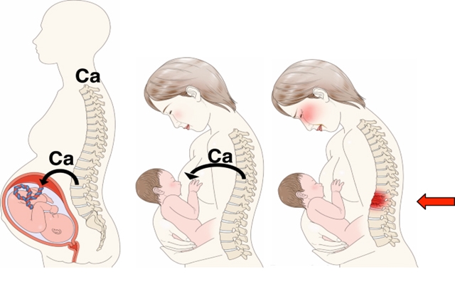 Vì sao phụ nữ sau sinh bị loãng xương?